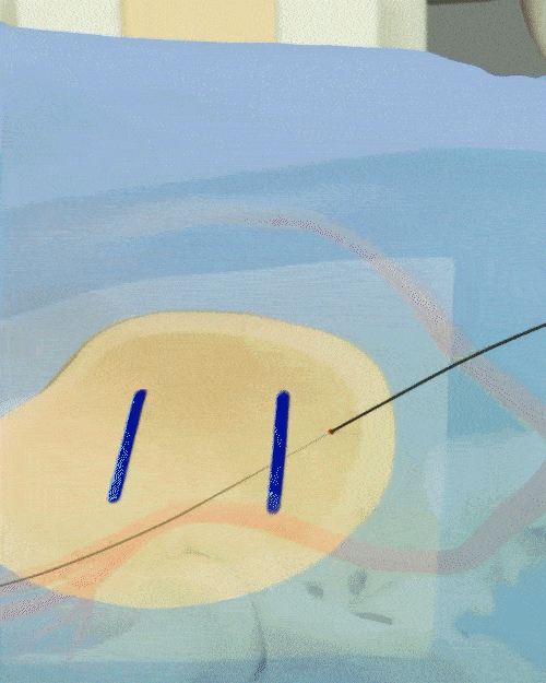 Interventional Radiology