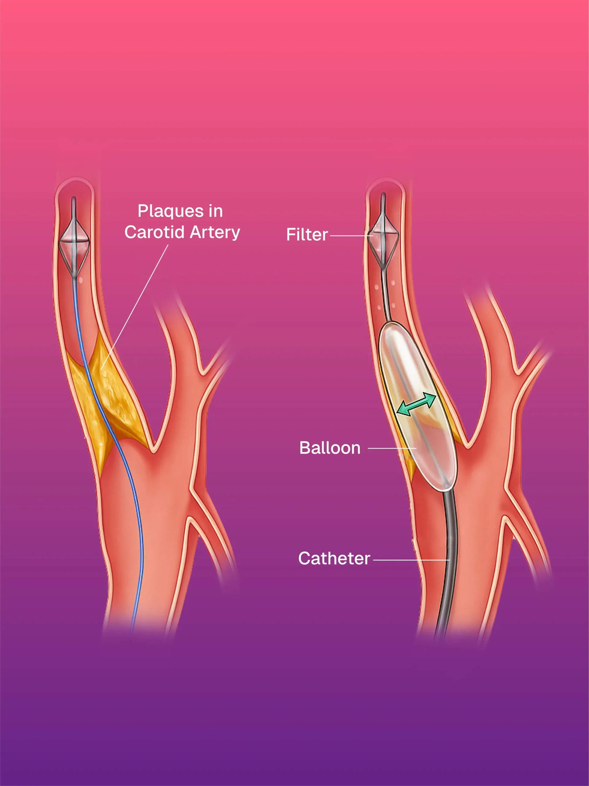 USG ve CT Kılavuzlu Pigtail/Drenaj