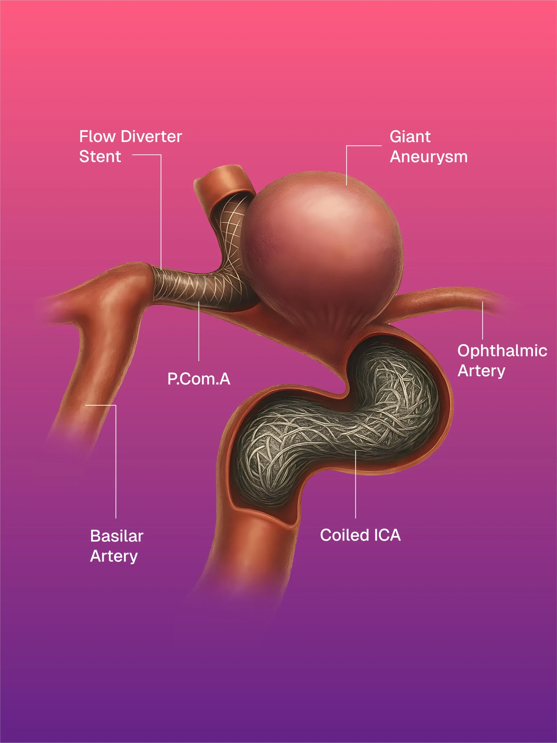 Hickman/Permcath Diyaliz Kateterleri