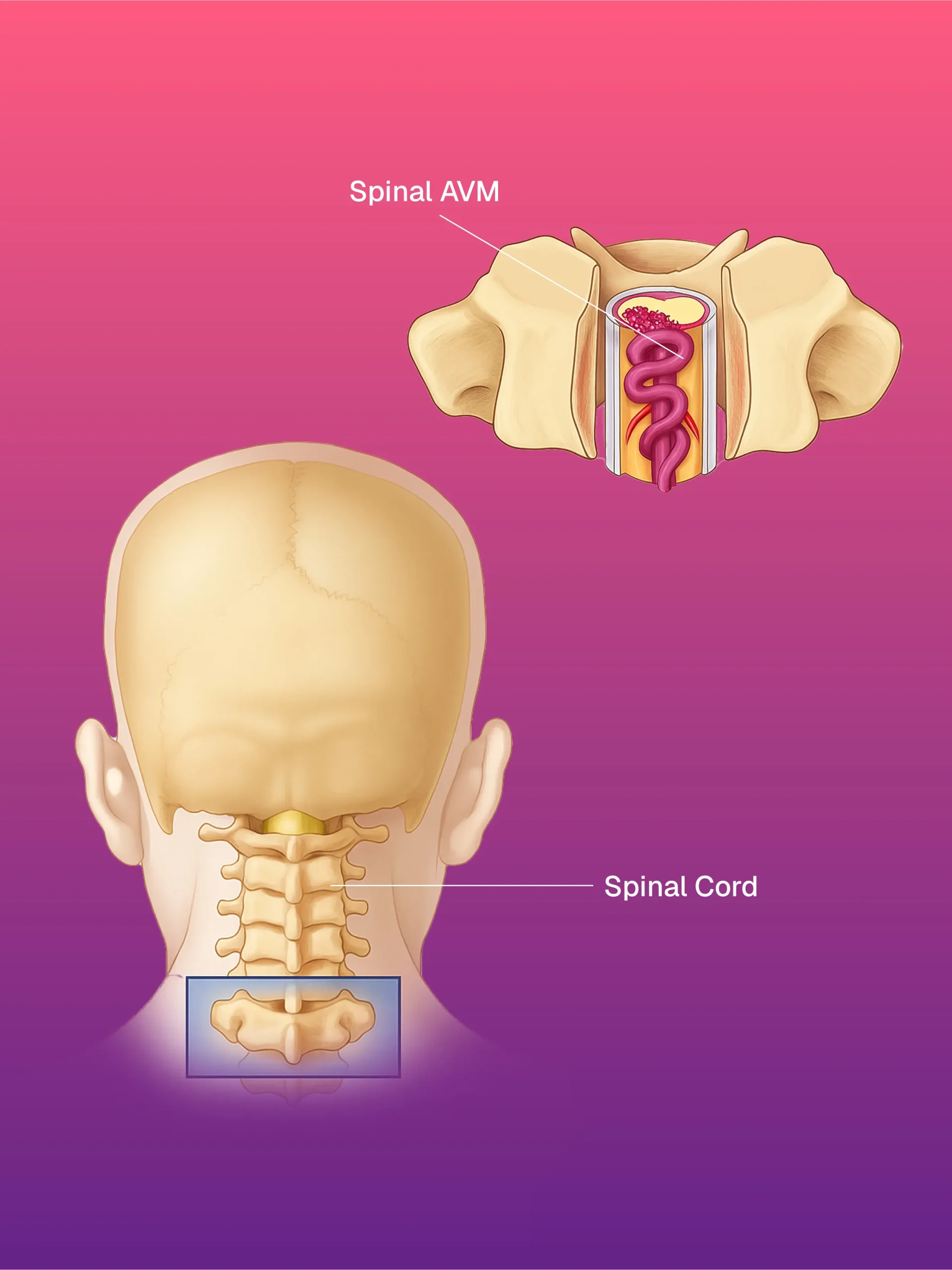 Kemoport Yerleştirme