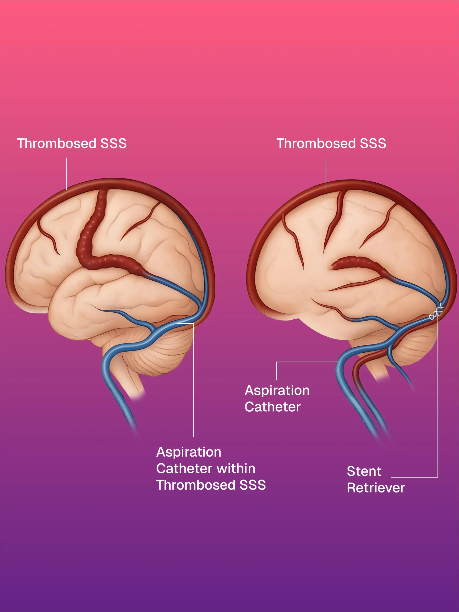 İntravasküler Yabancı Cisim Çıkarma
