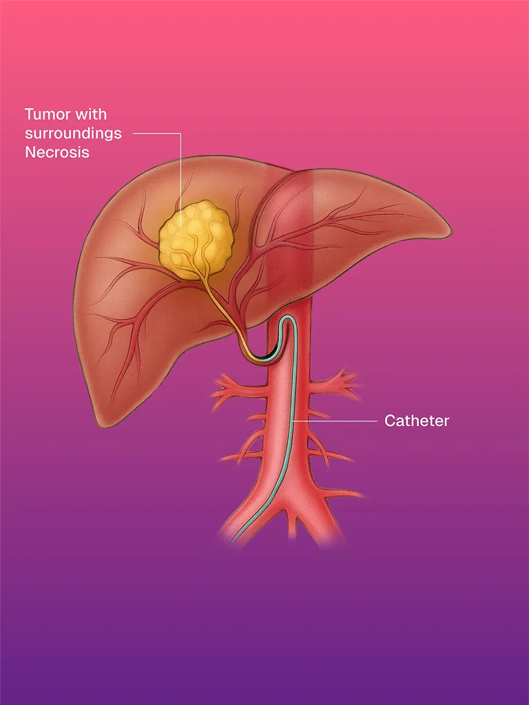 USG ve CT Kılavuzlu Pigtail/Drenaj