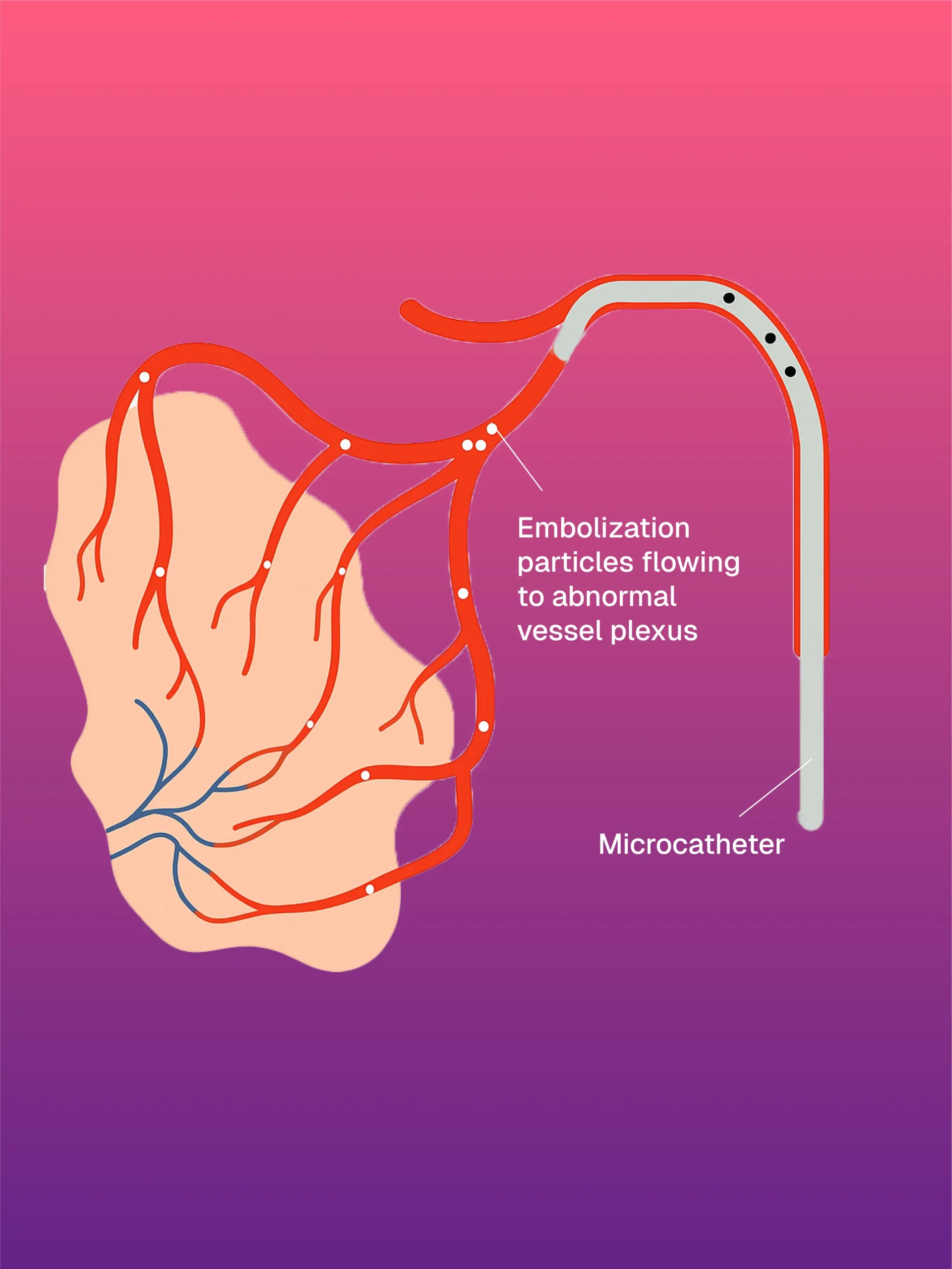 Hickman/Permcath Diyaliz Kateterleri