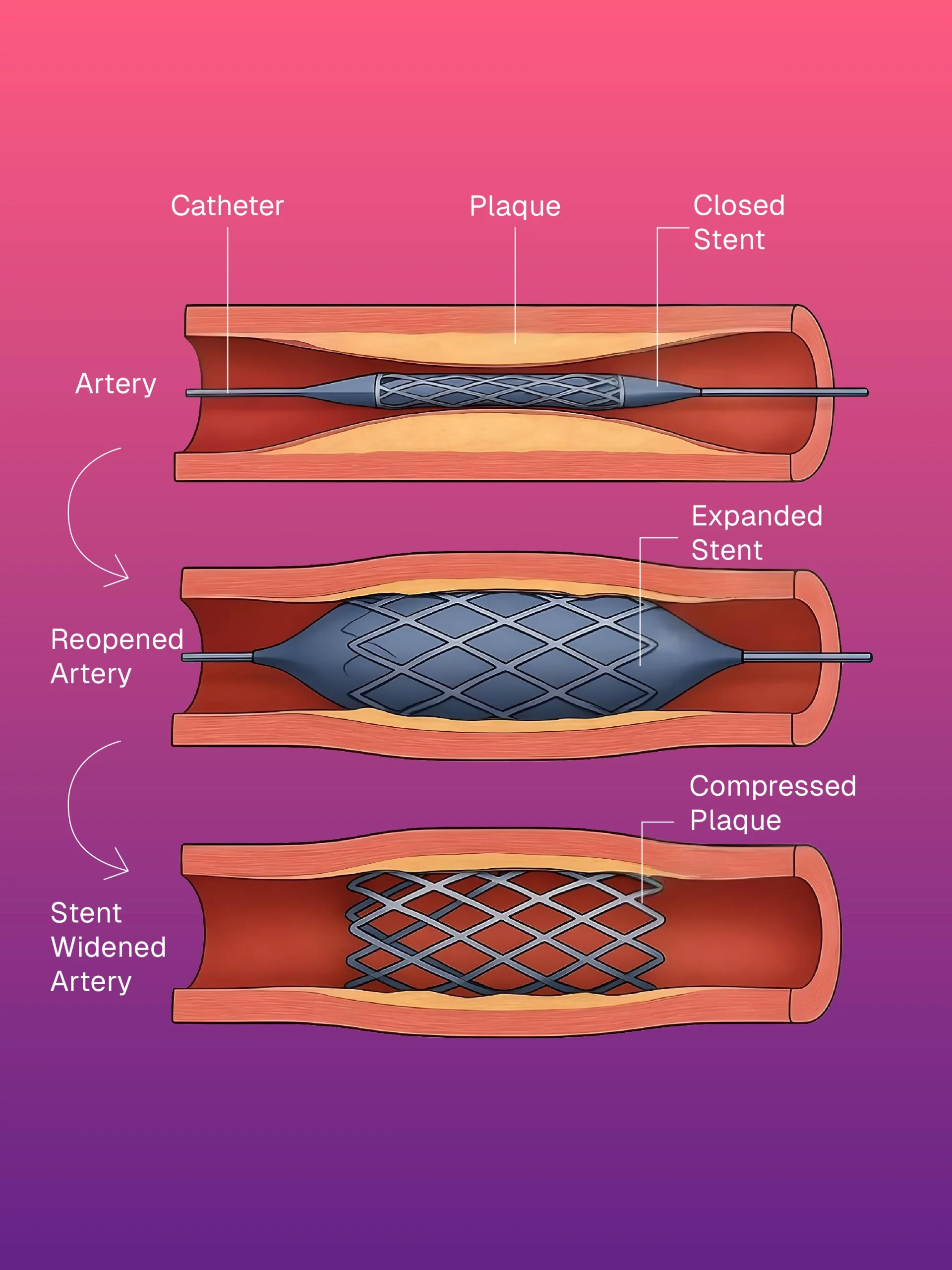 Kemoport Yerleştirme