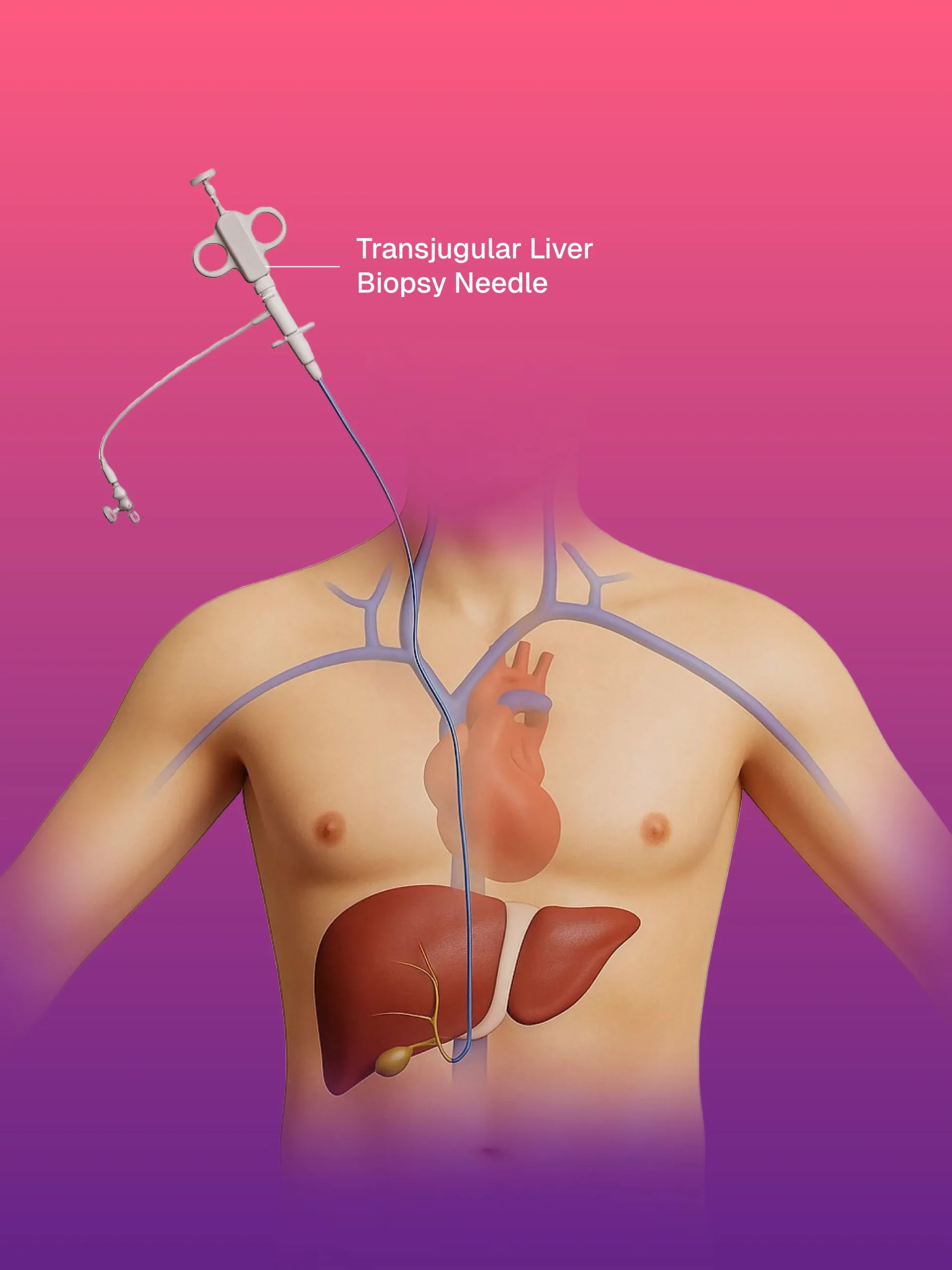 İntravasküler Yabancı Cisim Çıkarma