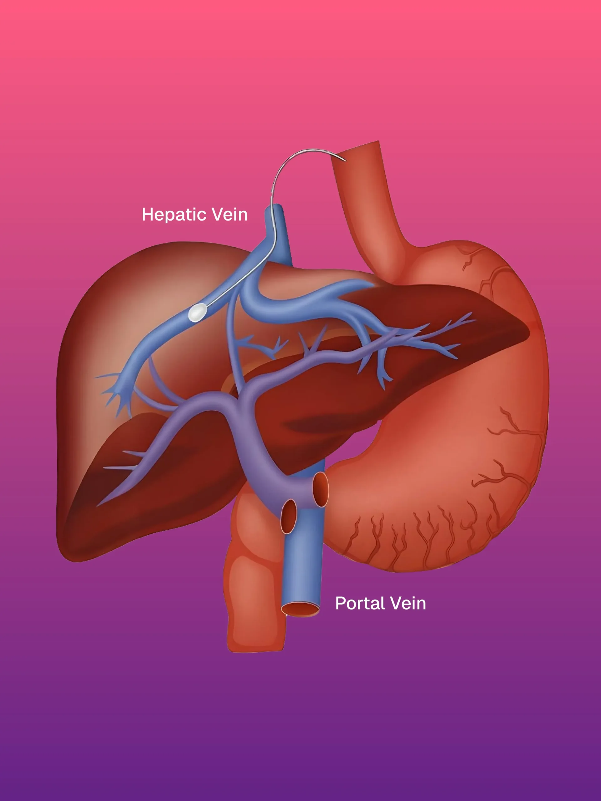 Santral Hat / Kateter