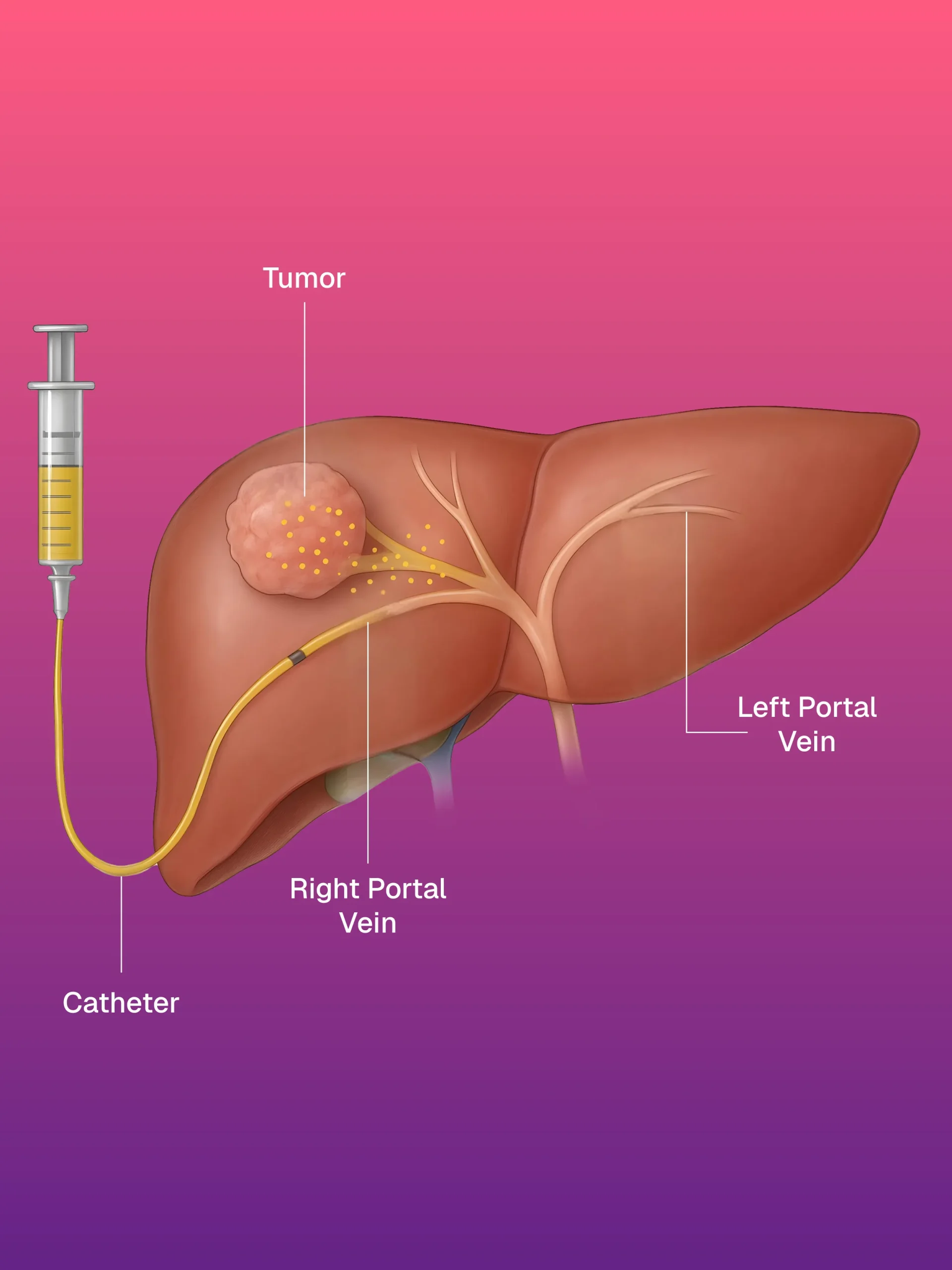 Vakum Destekli Meme Biyopsisi