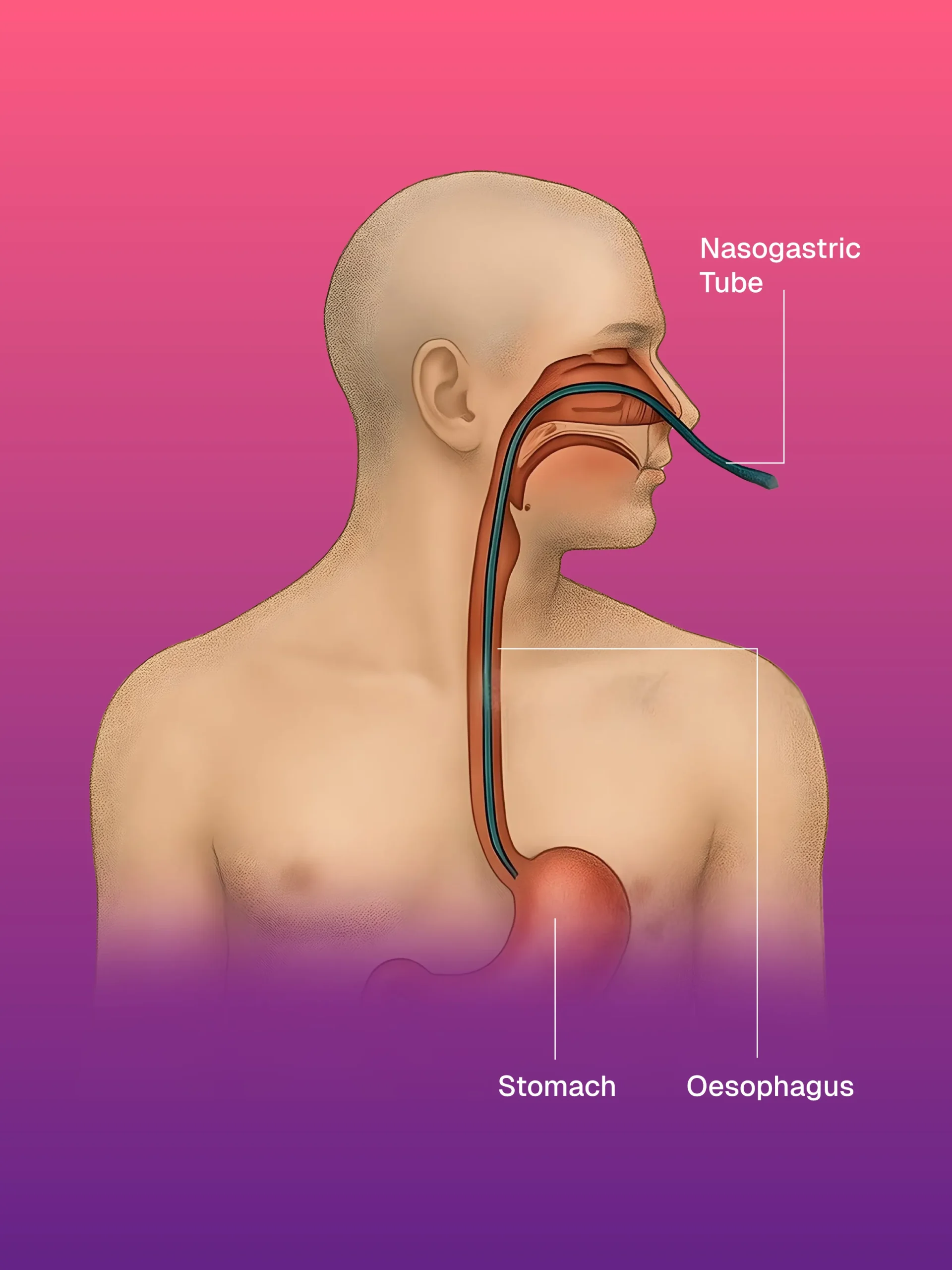 Vakum Destekli Meme Biyopsisi