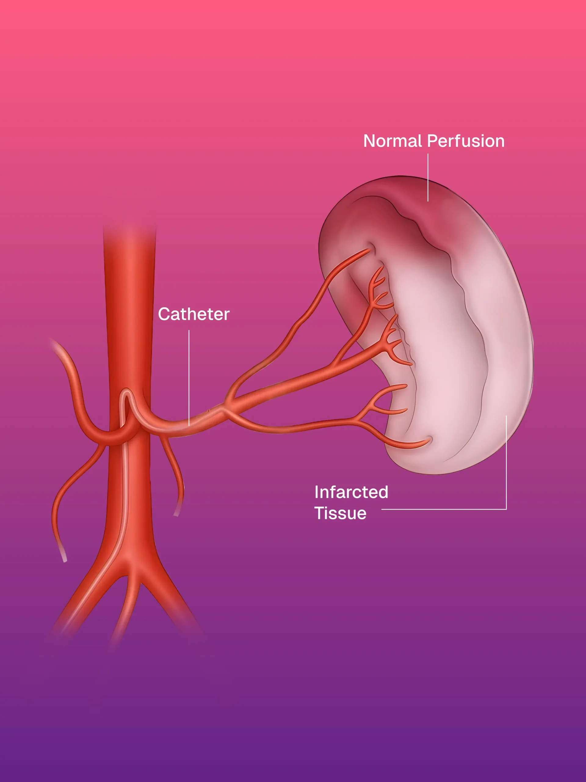 Vakum Destekli Meme Biyopsisi