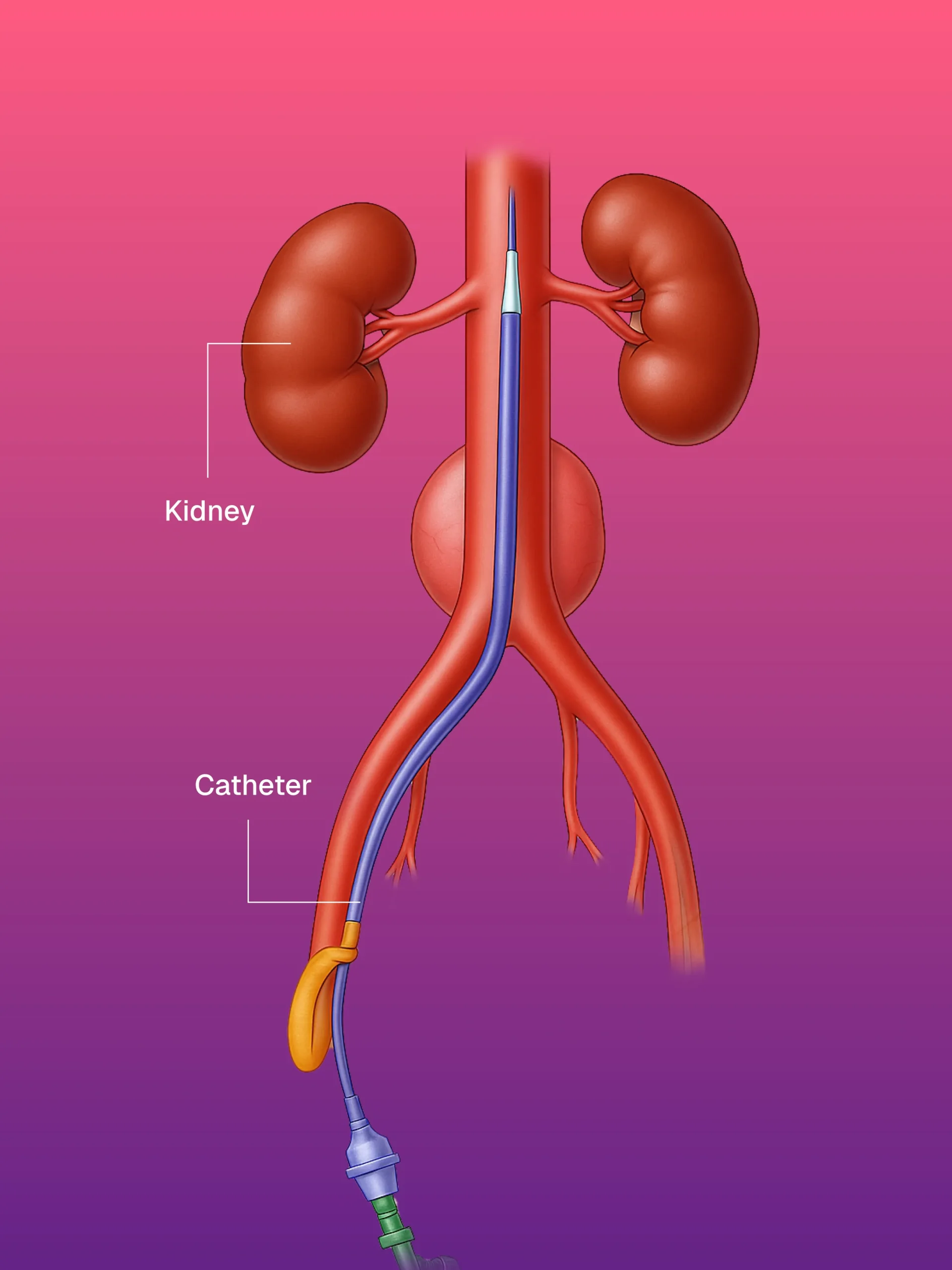 USG ve CT Kılavuzlu Pigtail/Drenaj