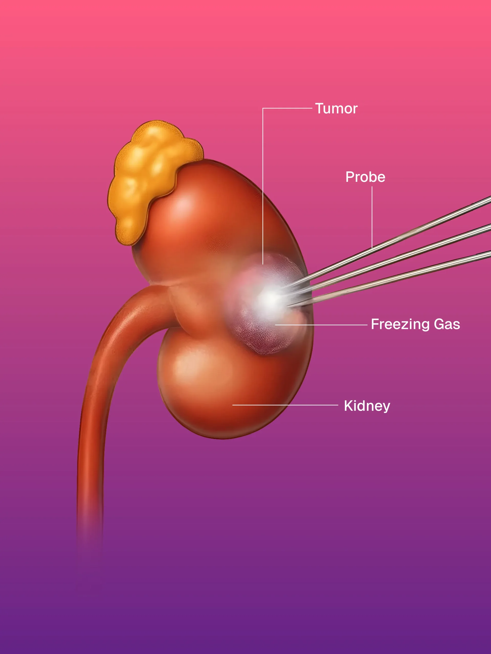 Hickman/Permcath Diyaliz Kateterleri