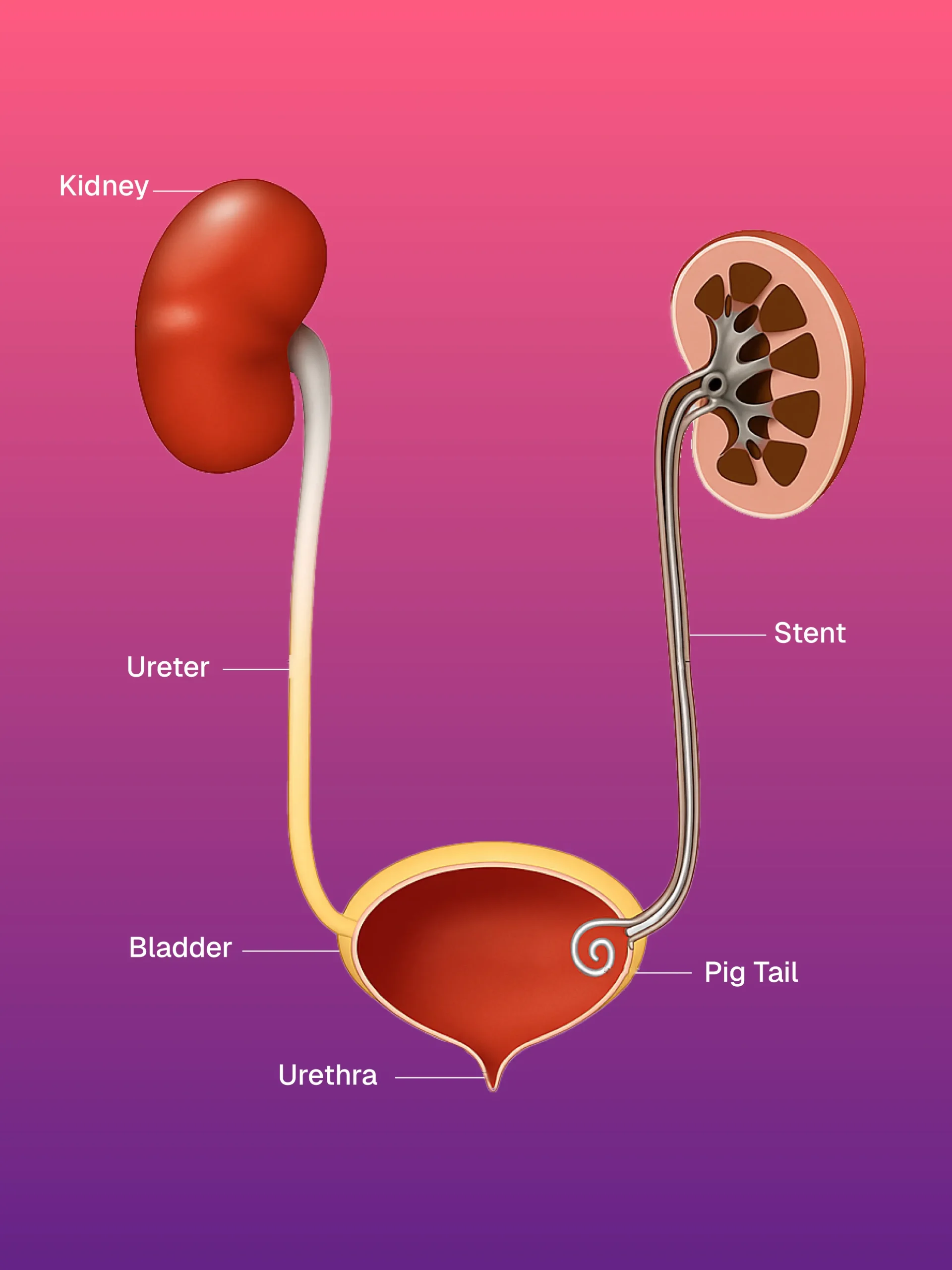 İntravasküler Yabancı Cisim Çıkarma