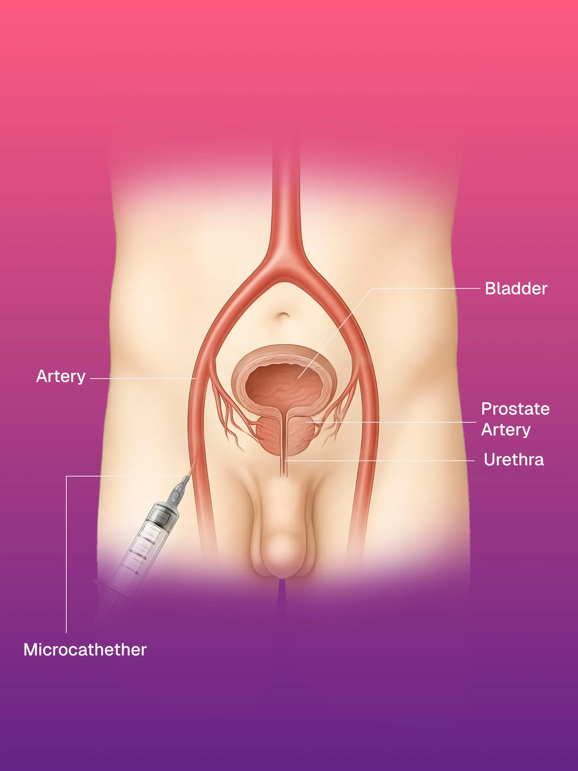 Vakum Destekli Meme Biyopsisi