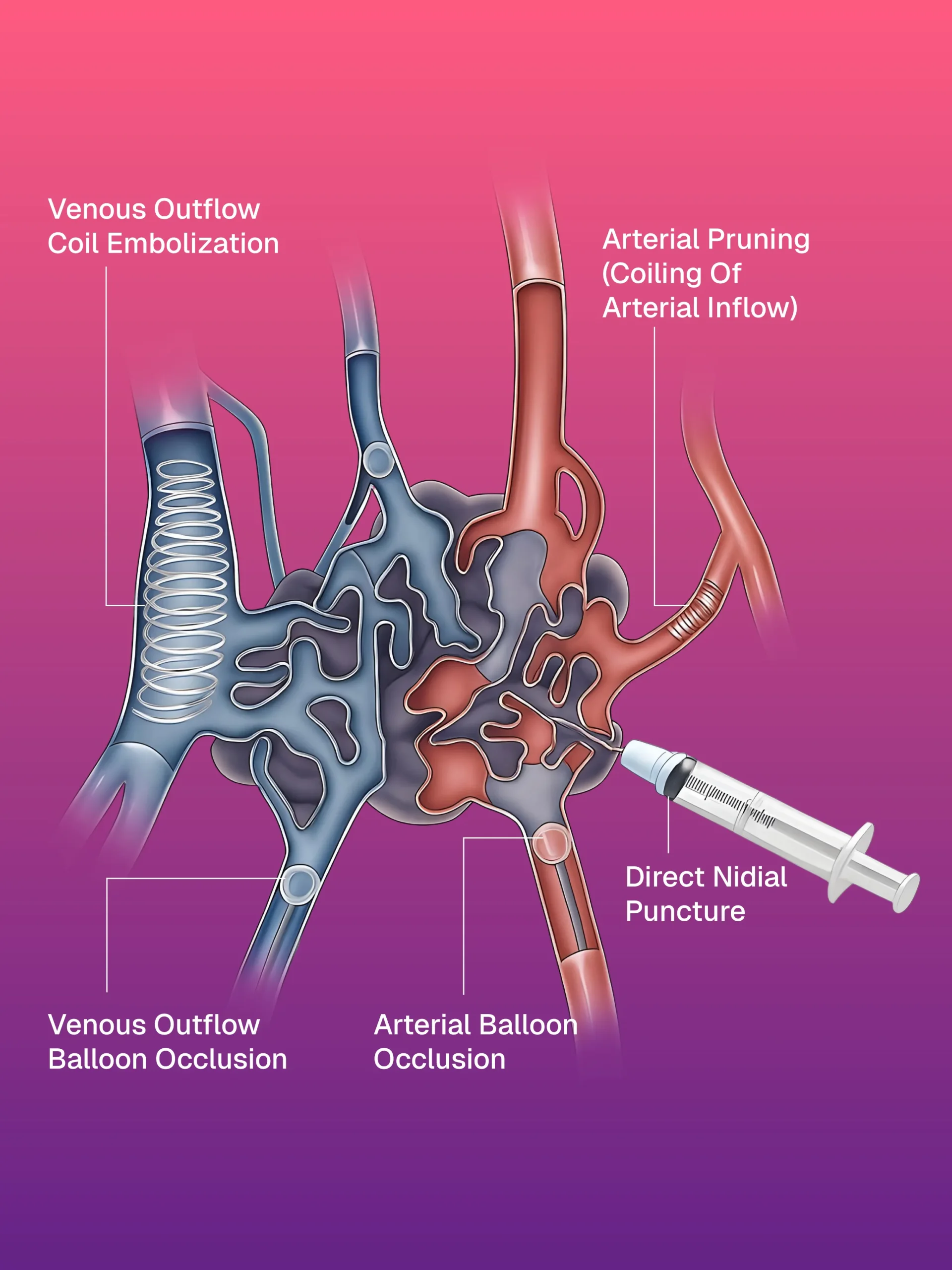 USG ve CT Kılavuzlu Pigtail/Drenaj