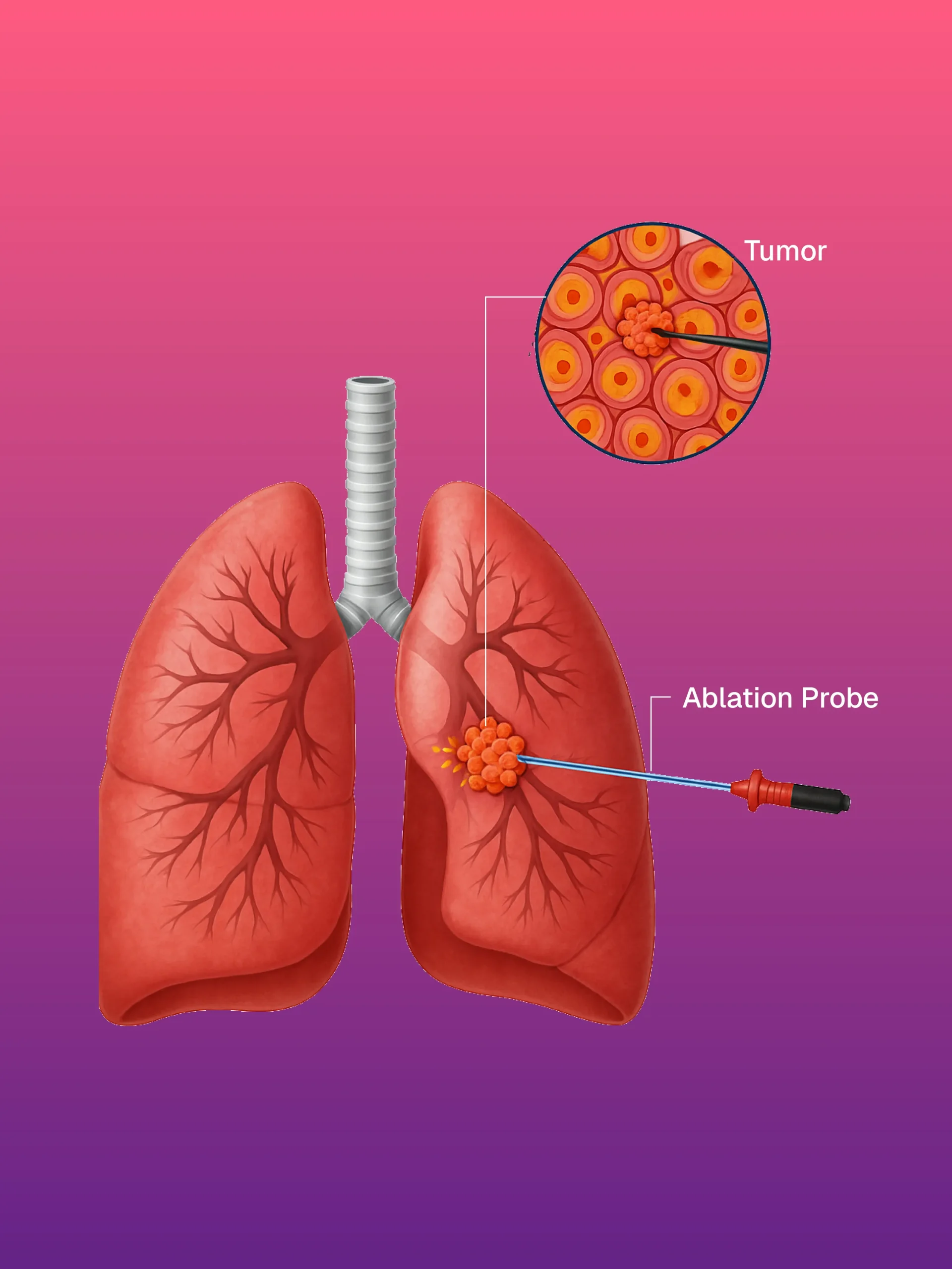 Hickman/Permcath Diyaliz Kateterleri