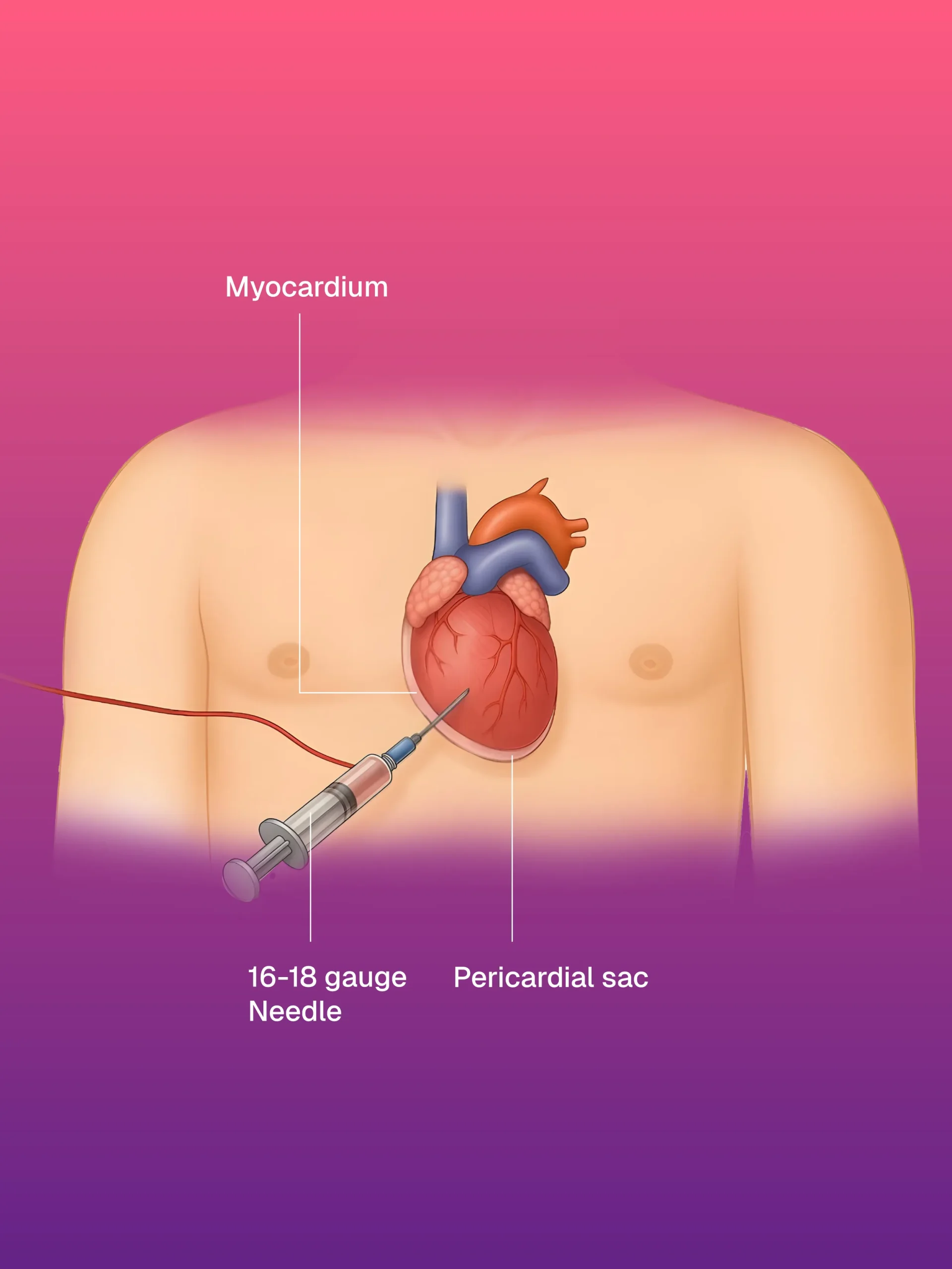 Vakum Destekli Meme Biyopsisi