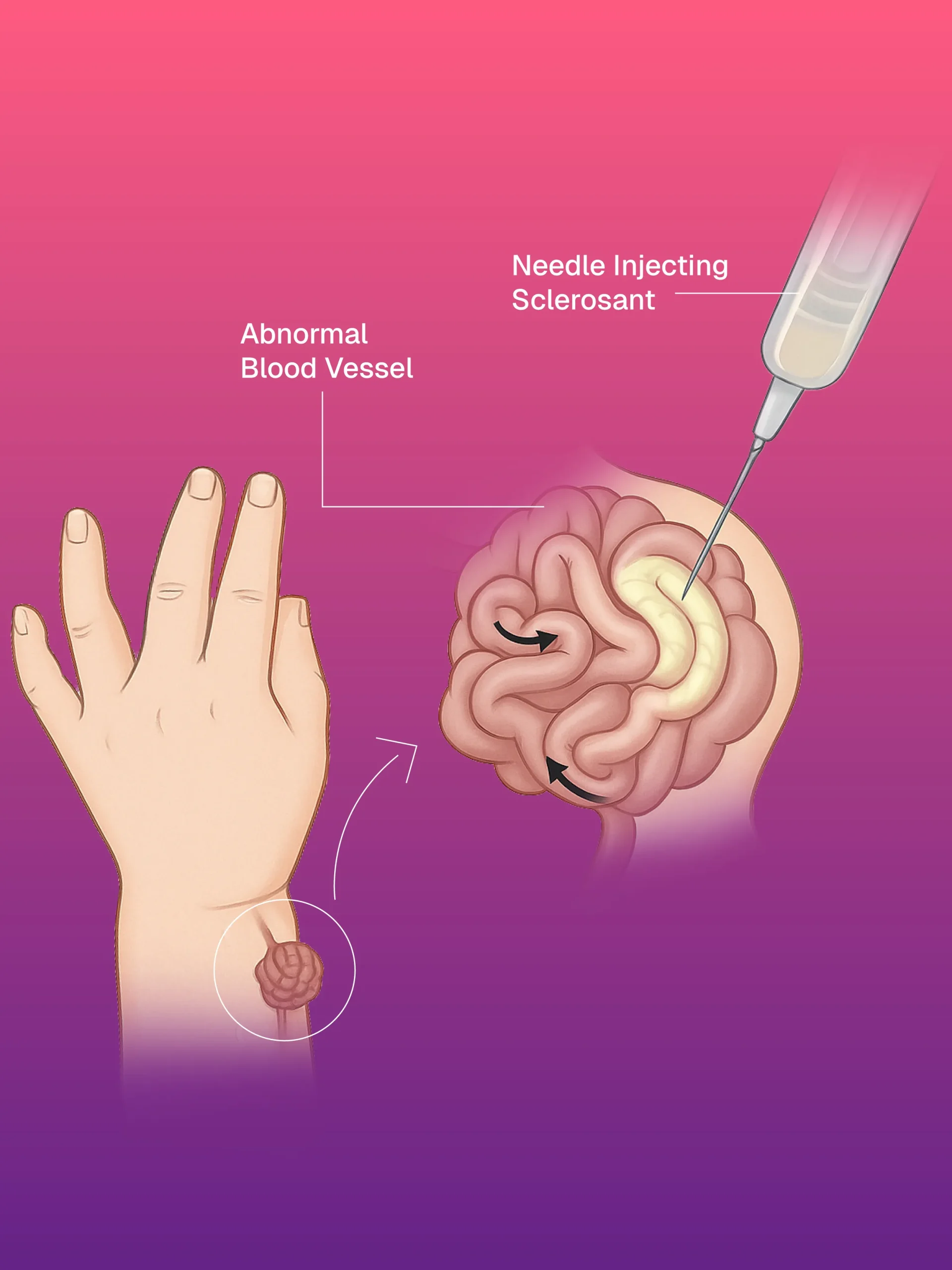 USG ve CT Kılavuzlu Pigtail/Drenaj