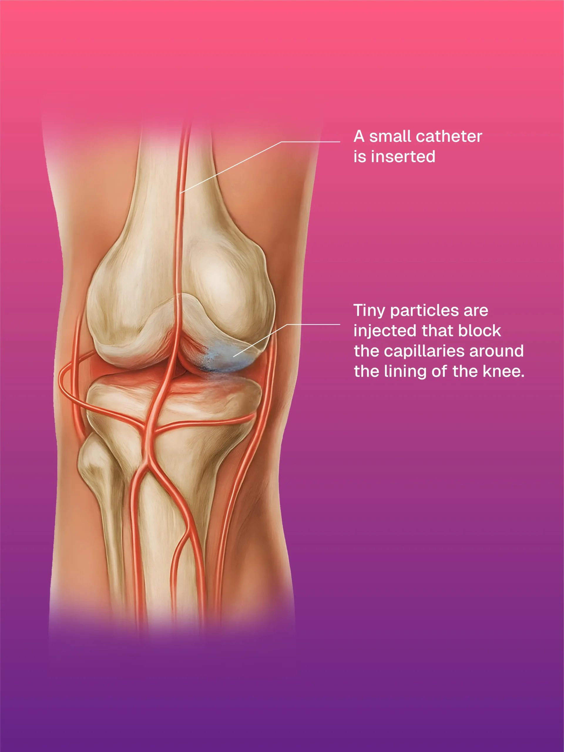 Hickman/Permcath Diyaliz Kateterleri