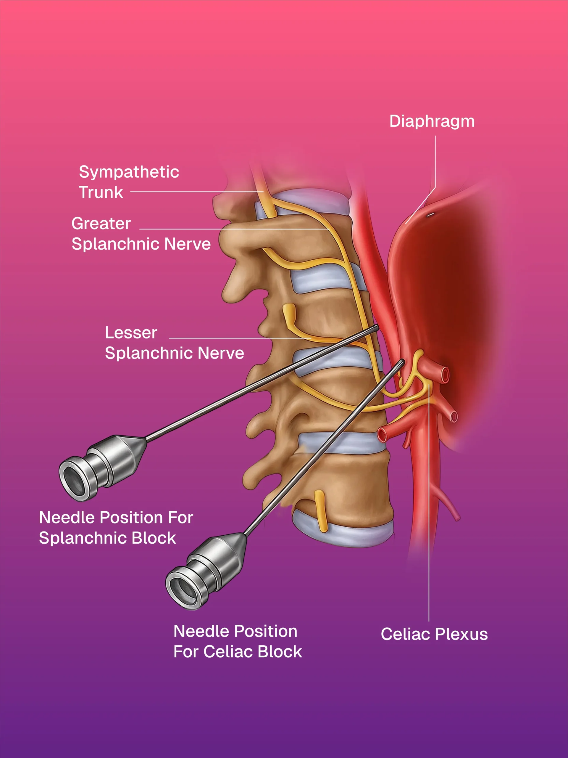 İntravasküler Yabancı Cisim Çıkarma