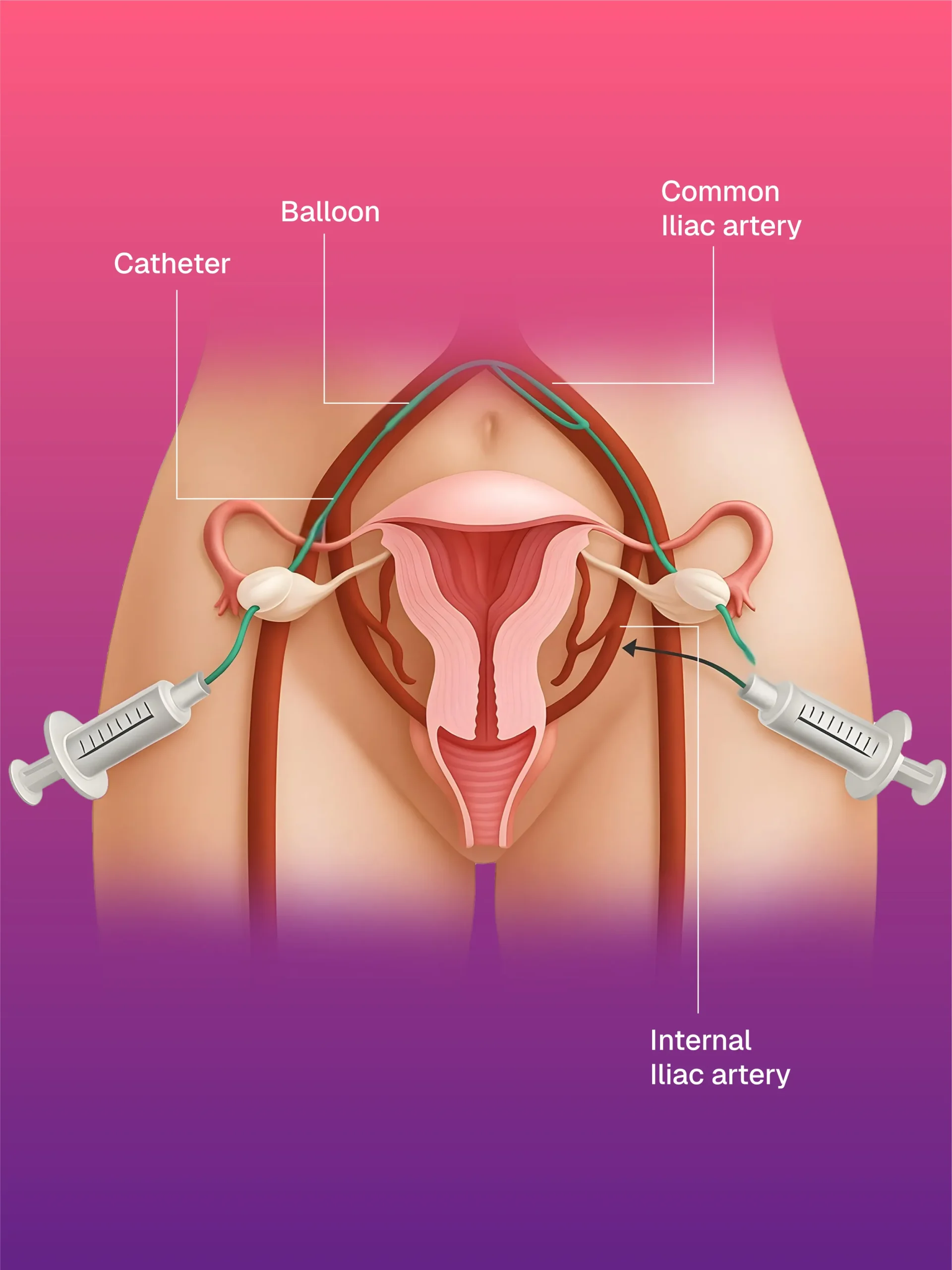 USG ve CT Kılavuzlu Pigtail/Drenaj