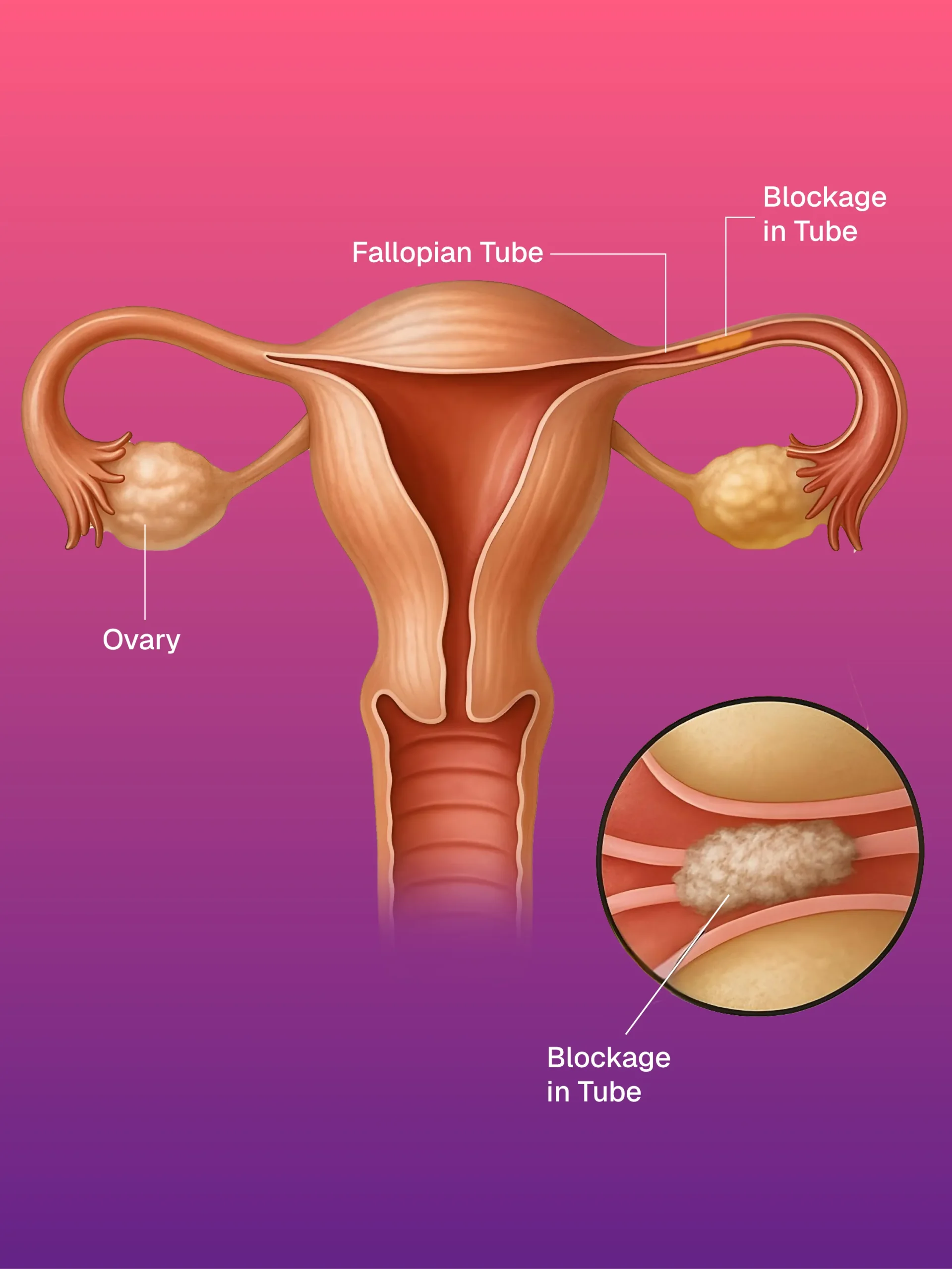 Hickman/Permcath Diyaliz Kateterleri