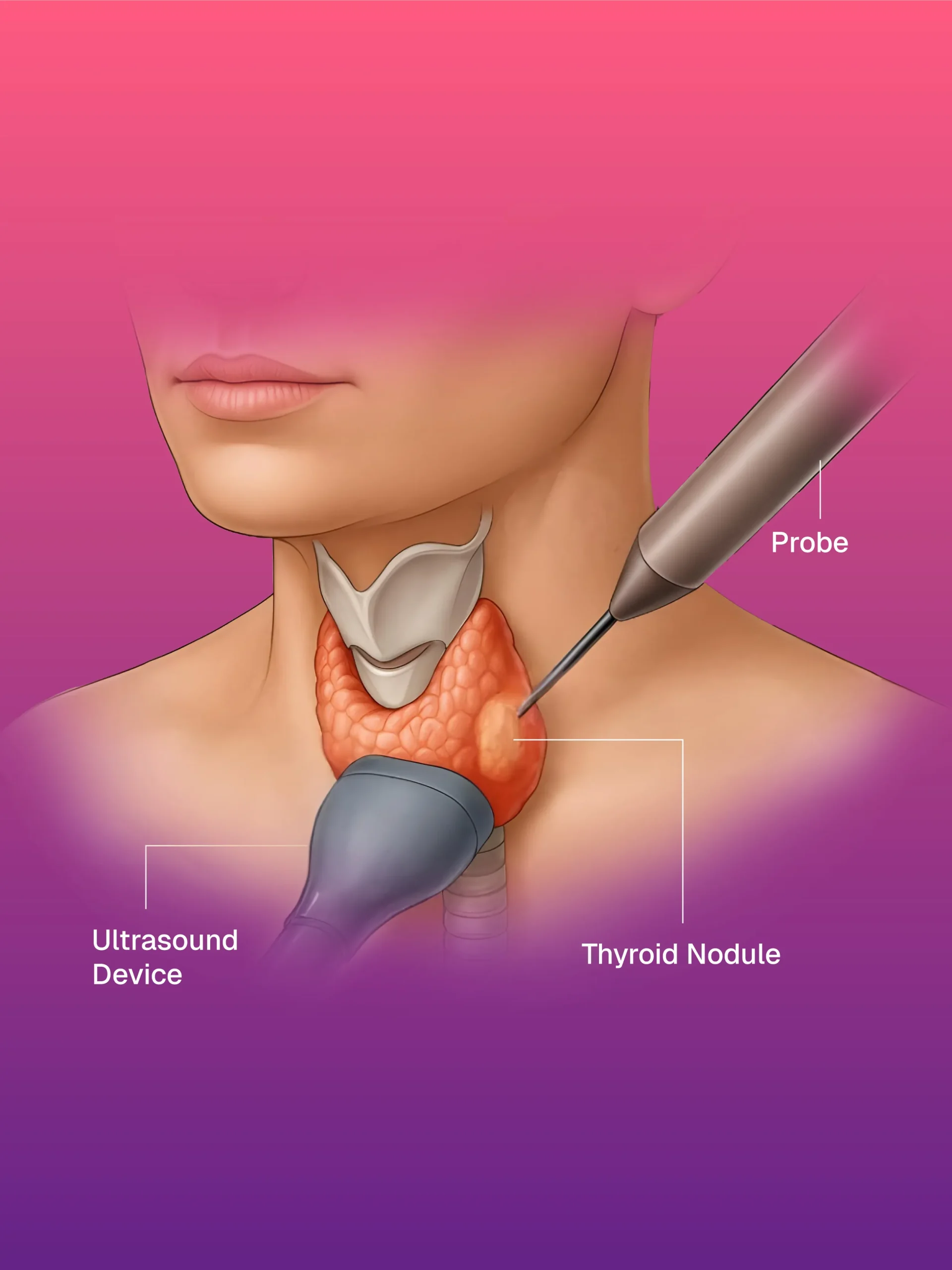 USG ve CT Kılavuzlu Pigtail/Drenaj