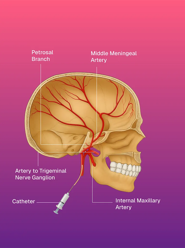 Vakum Destekli Meme Biyopsisi