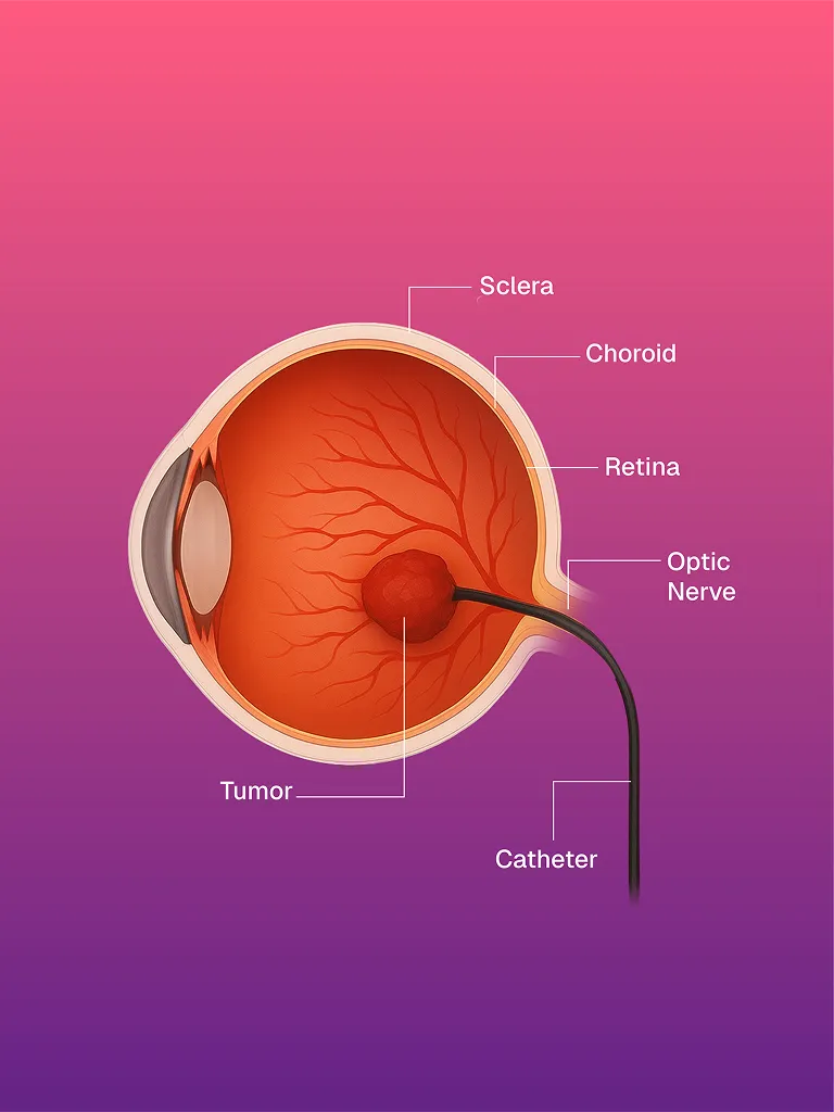 Vakum Destekli Meme Biyopsisi