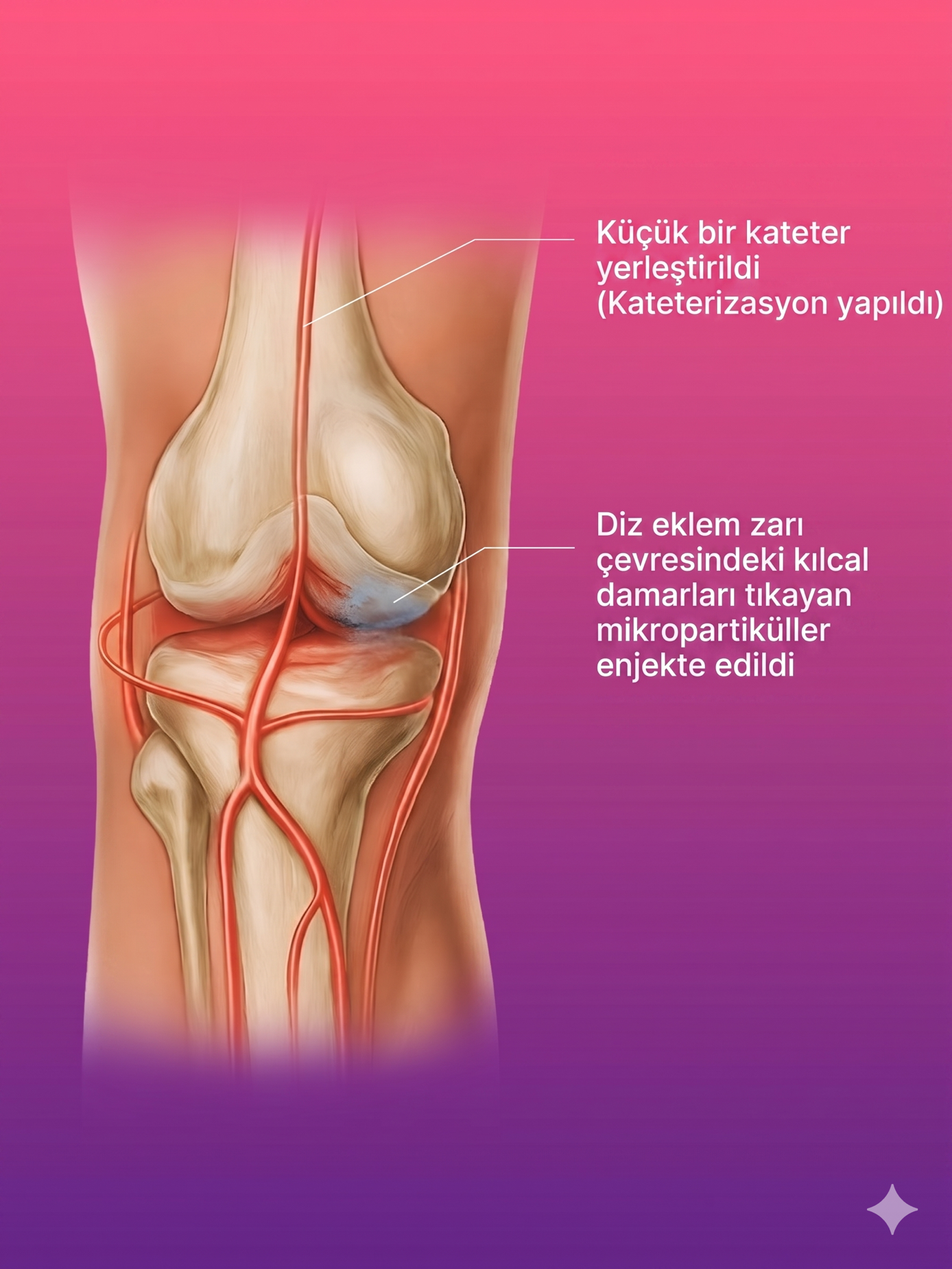 Diz Ağrısında Geniküler Arter Embolizasyon Tedavisi